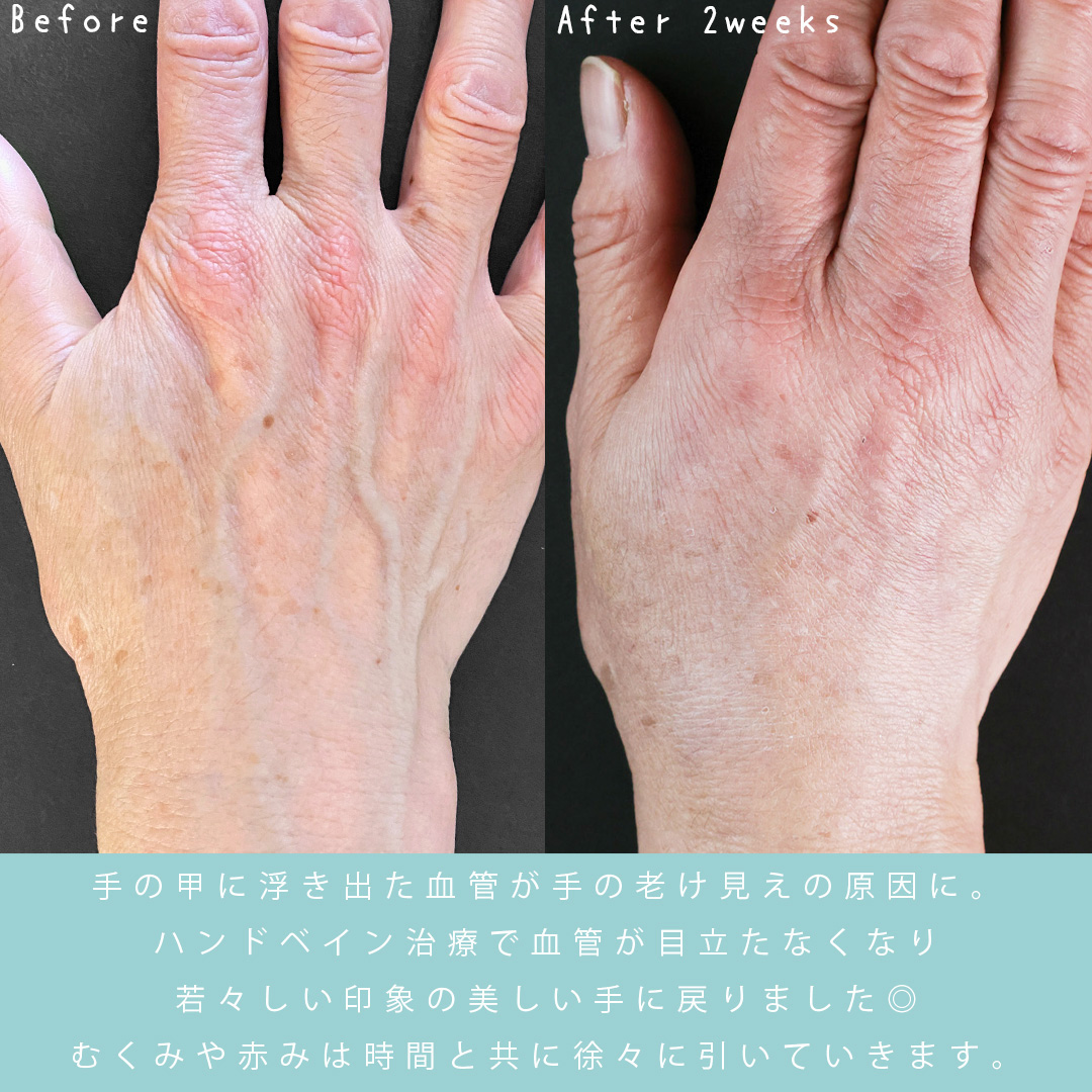 ハンドベイン（手のアンチエイジング・血管治療）の症例写真 施術前後 
