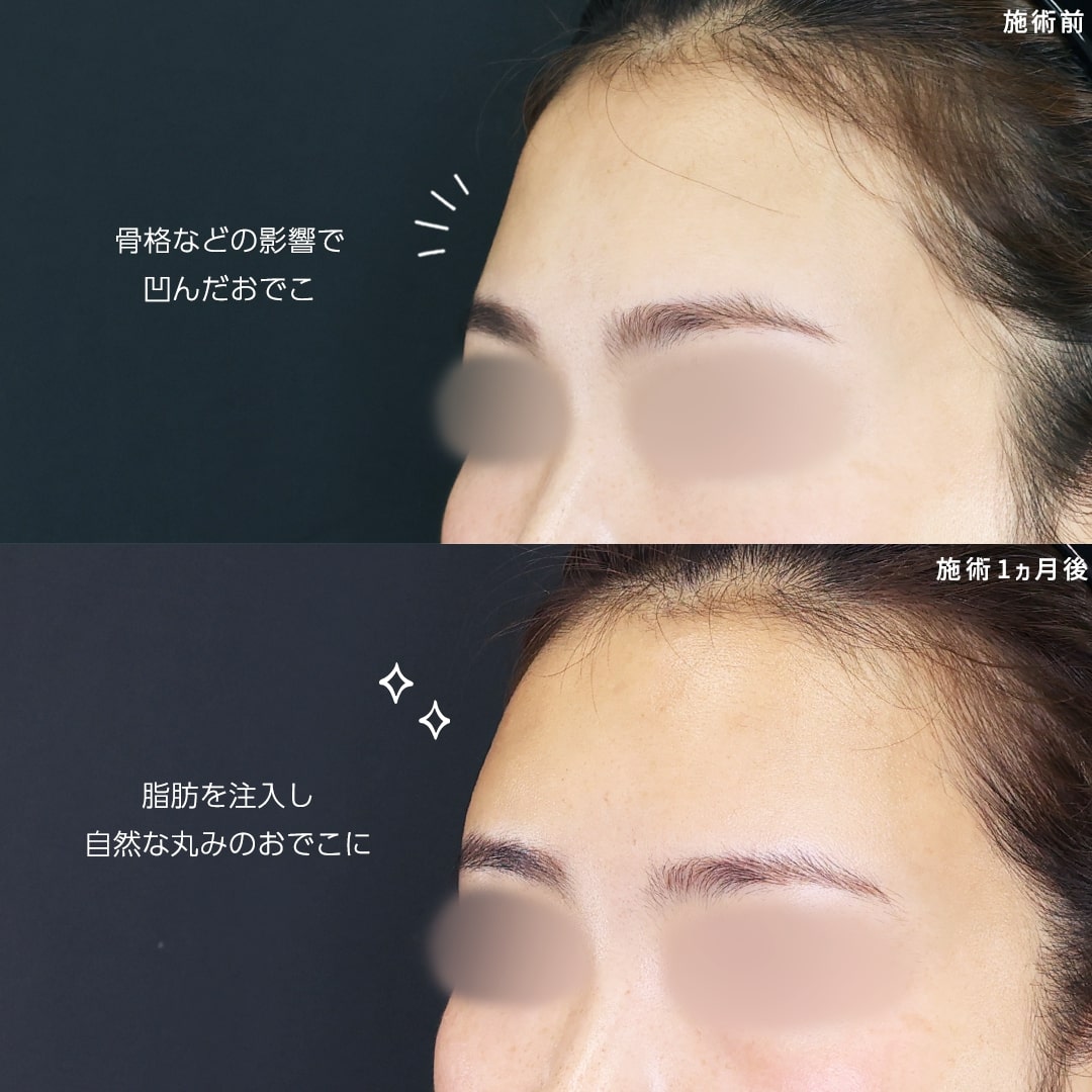 顔の脂肪注入(コンデンスリッチフェイス)の症例写真 施術前後 