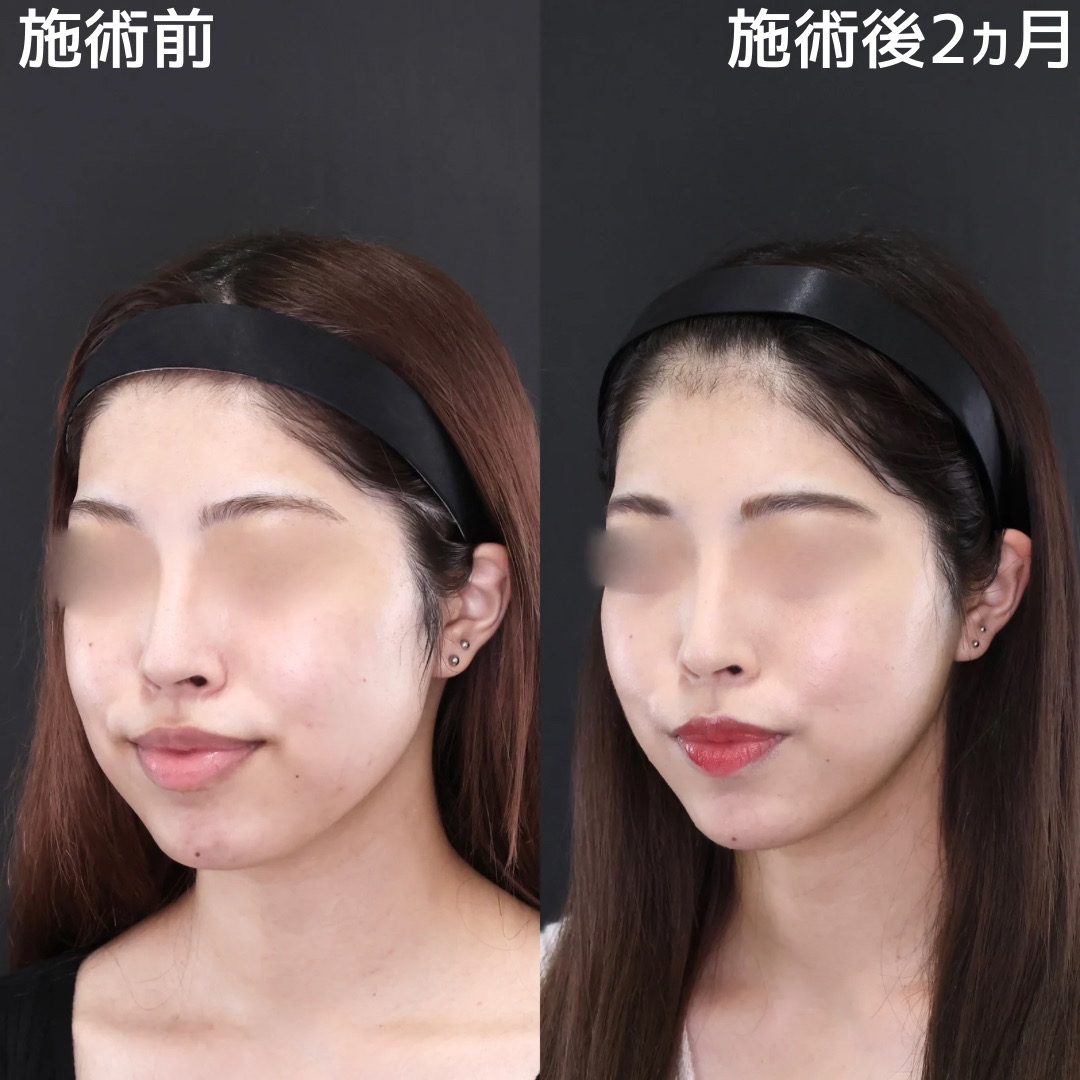 【糸リフト×脂肪除去】頬のボリュームを撃退！小顔で美人度UP