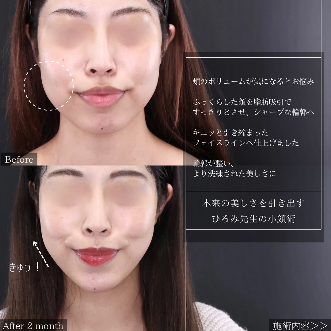 TAC式 ツヤ肌コラーゲンリフト®/顎下の脂肪吸引・顔の脂肪吸引/エラボトックス注射の症例写真 施術前後 