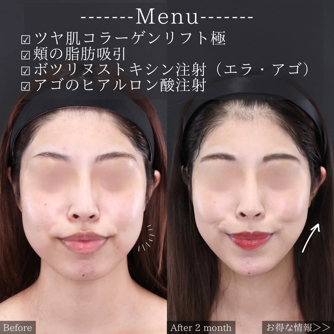 TAC式 ツヤ肌コラーゲンリフト®/顎下の脂肪吸引・顔の脂肪吸引/エラボトックス注射の症例写真 施術前後 