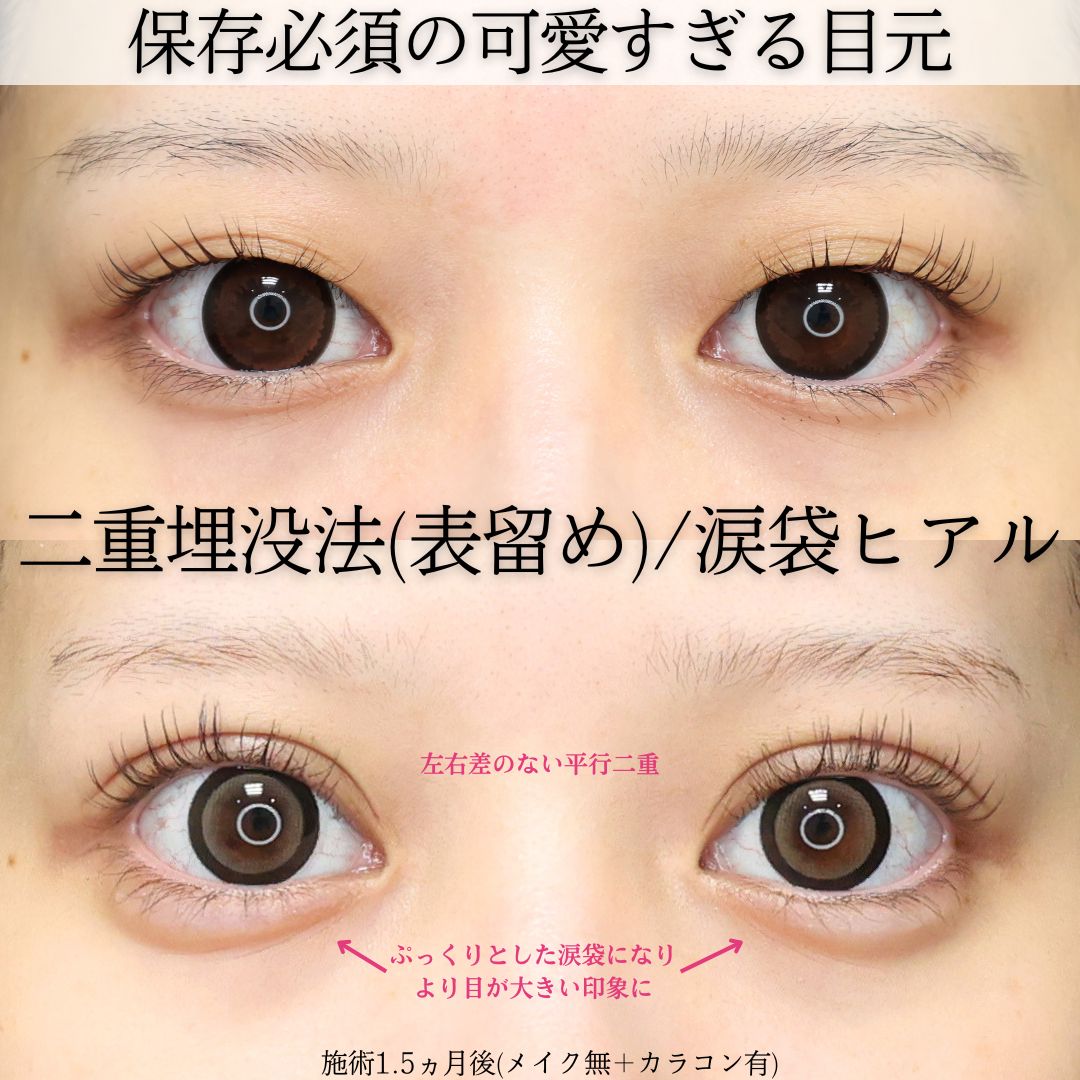 二重埋没法/涙袋形成（ヒアルロン酸注射）の症例写真 施術前後 