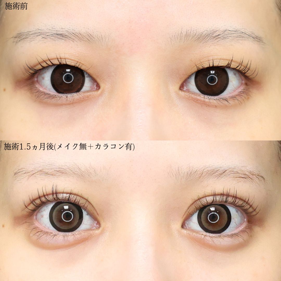 二重埋没法/涙袋形成（ヒアルロン酸注射）の症例写真 施術前後 