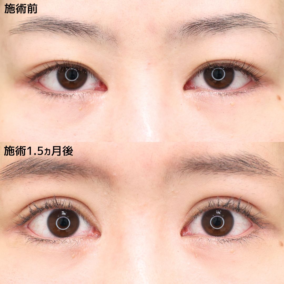 《埋没法》約30分の施術で憧れの平行二重