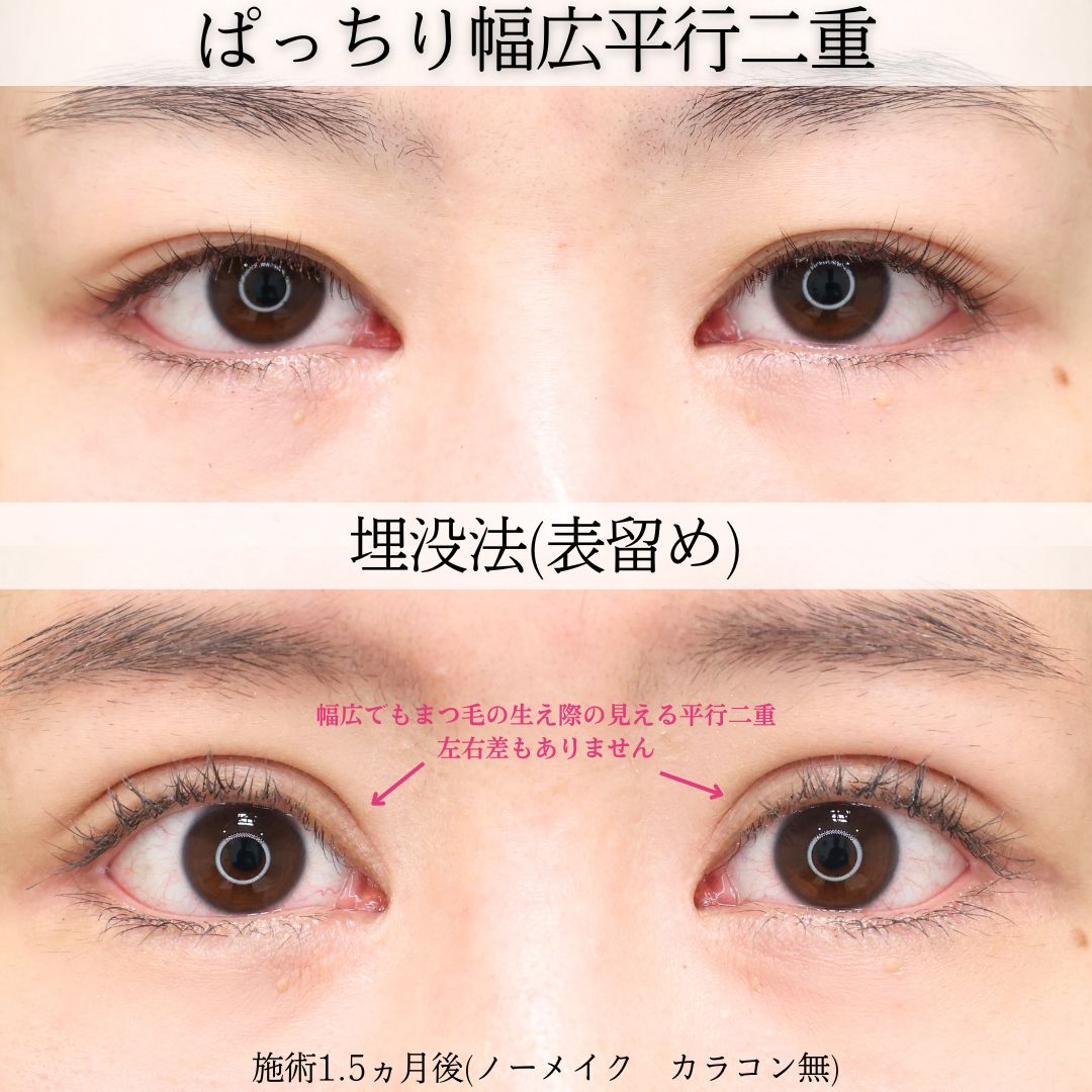 二重埋没法の症例写真 施術前後 