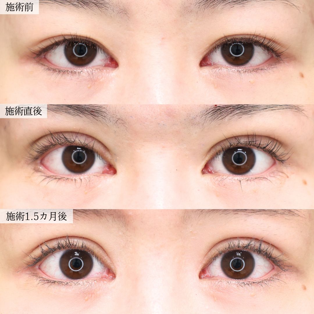 二重埋没法の症例写真 施術前後 