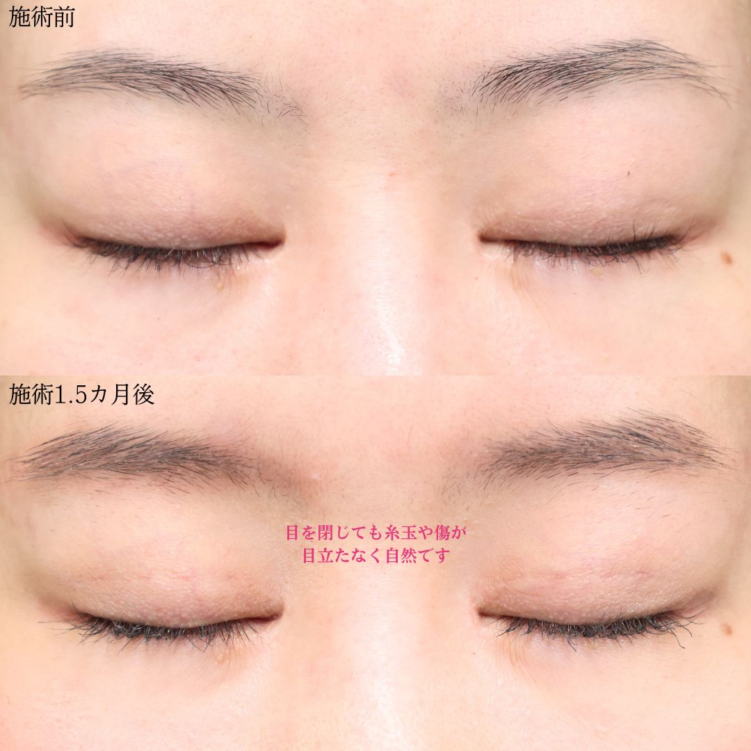 二重埋没法の症例写真 施術前後 