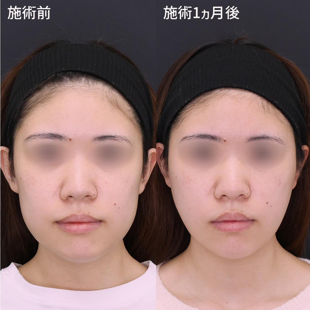 【糸リフト】【脂肪除去】整形感無くナチュラルに変化する小顔術