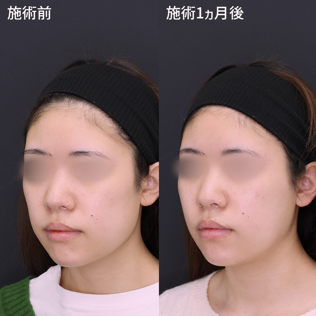 TAC式 ツヤ肌コラーゲンリフト®/Lラインファット除去（エラ下脂肪除去）/顎下の脂肪吸引の症例写真 施術前後 