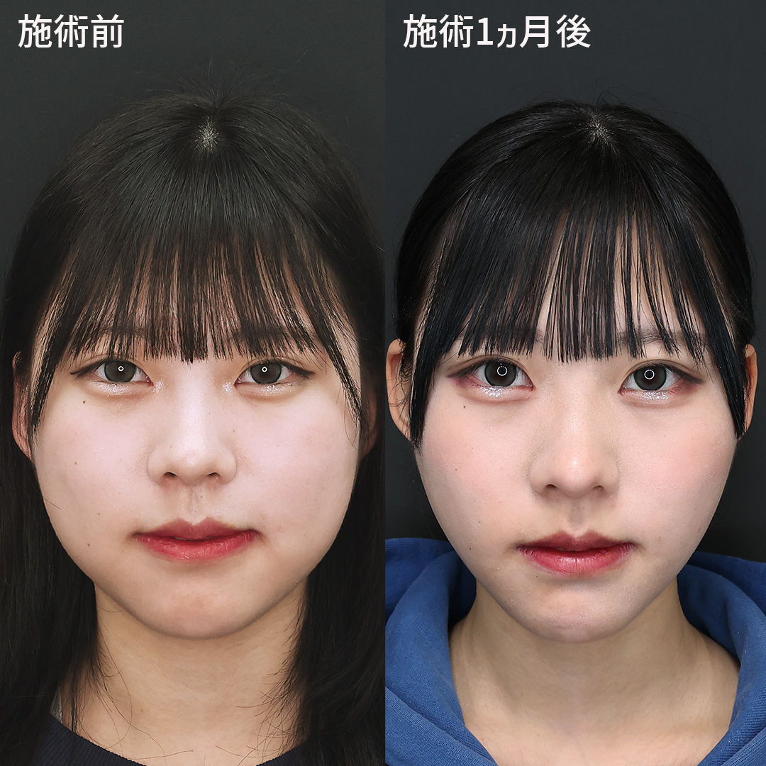 お顔についた余分な脂肪をとって洗練された小顔美人へ