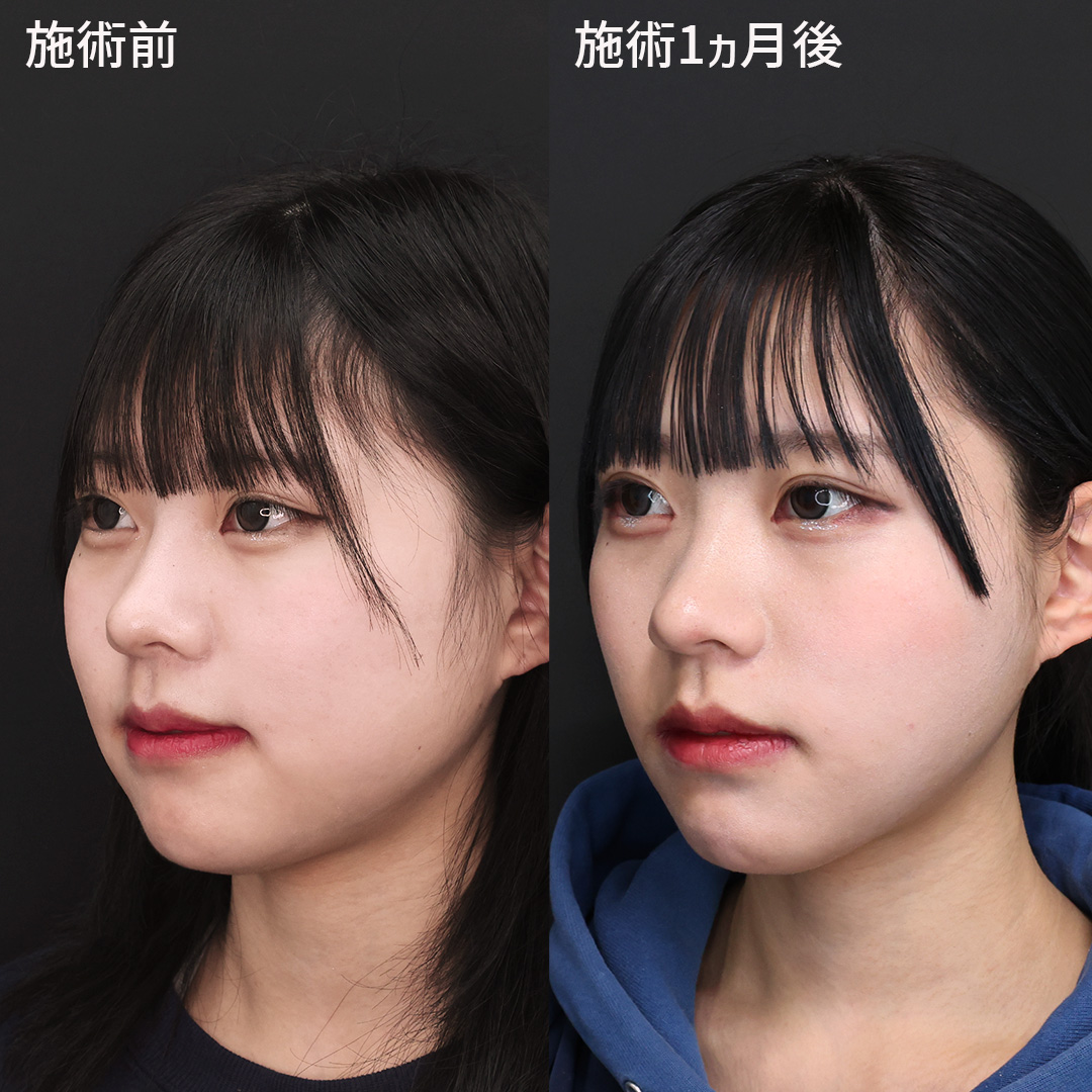 TAC式 ツヤ肌コラーゲンリフト®/顎下の脂肪吸引/エラボトックス注射の症例写真 施術前後 