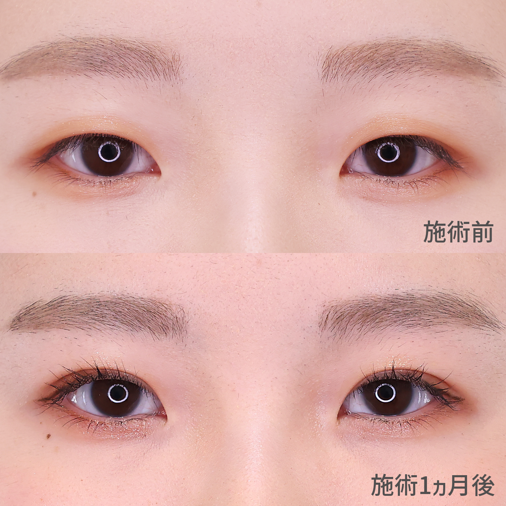 【二重埋没法】整形感の無いナチュラルな末広型二重へ