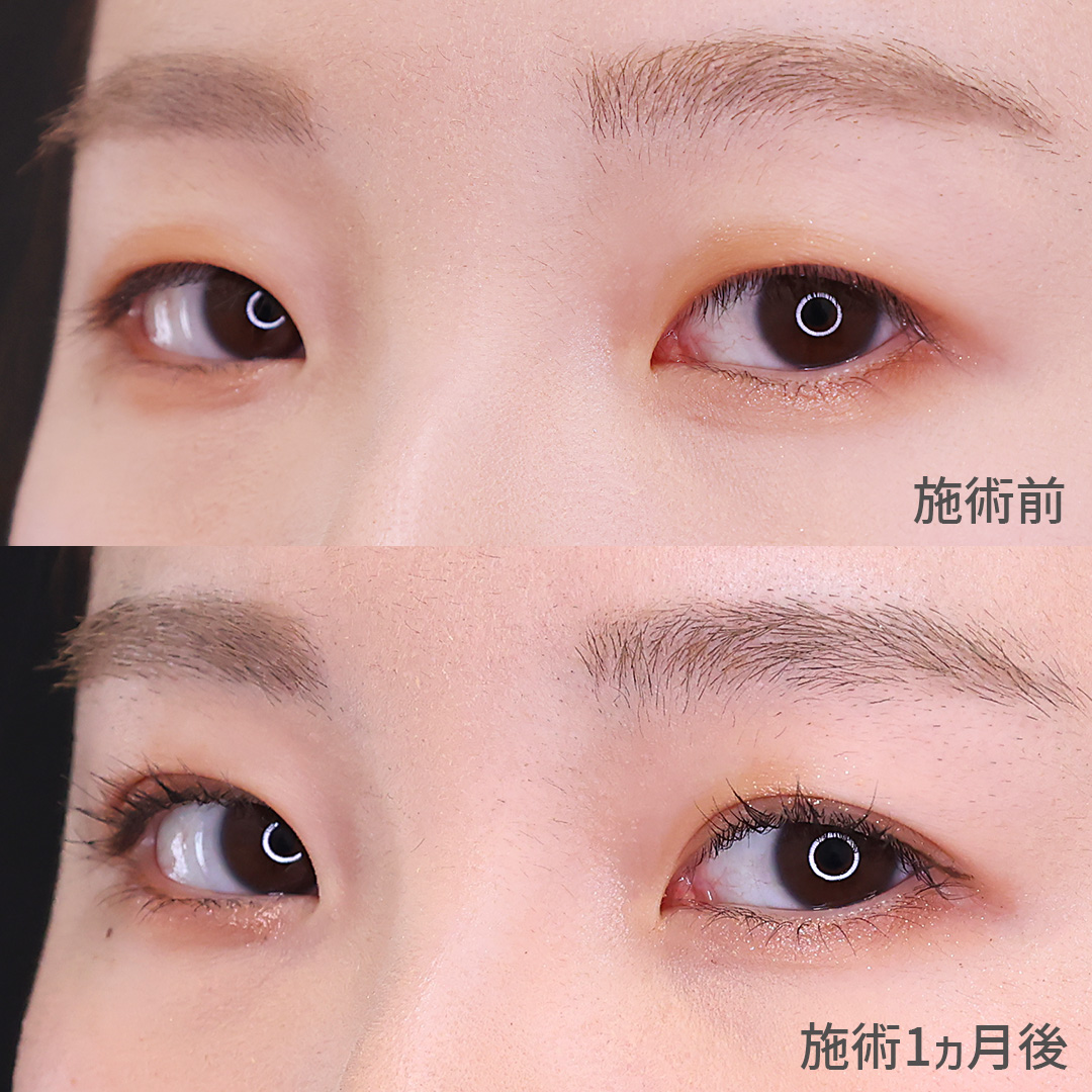 二重埋没法の症例写真 施術前後 