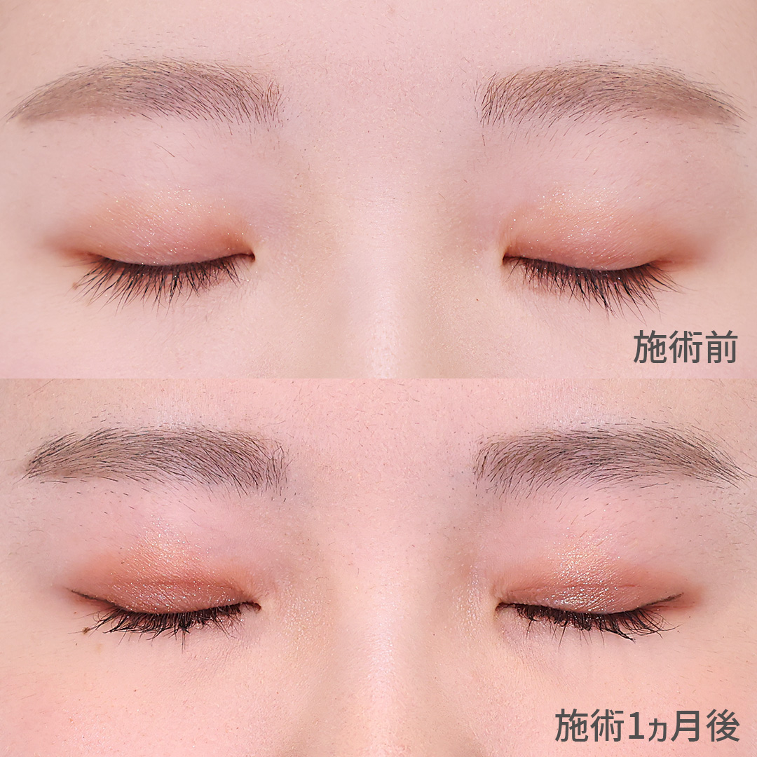 二重埋没法の症例写真 施術前後 