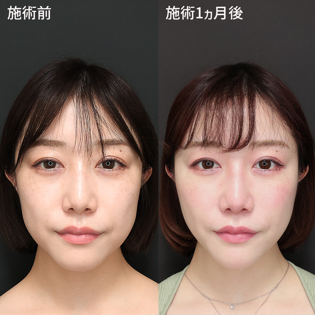 TAC式 ツヤ肌コラーゲンリフト®/エラボトックス注射/顎のヒアルロン酸注射の症例写真 施術前後