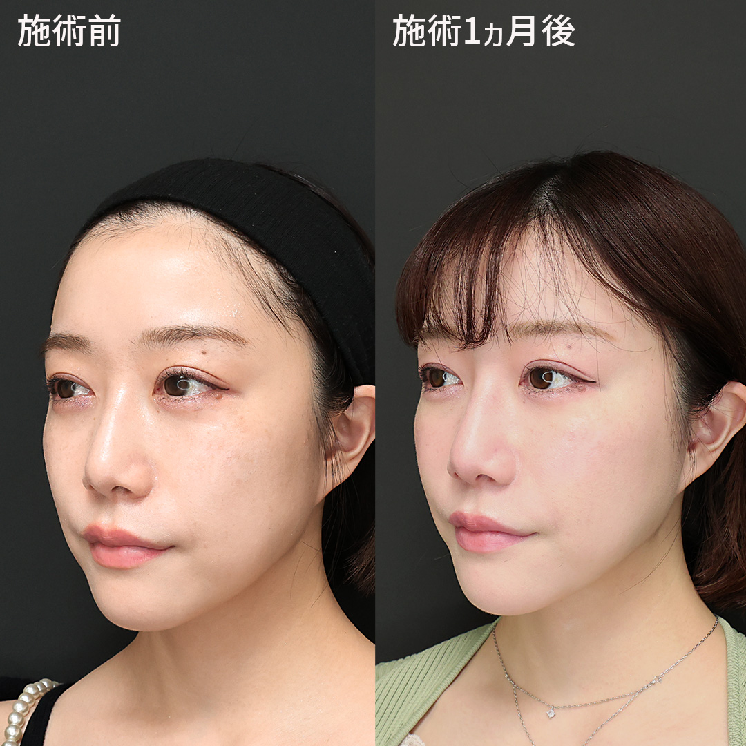 TAC式 ツヤ肌コラーゲンリフト®/エラボトックス注射/顎のヒアルロン酸注射の症例写真 施術前後