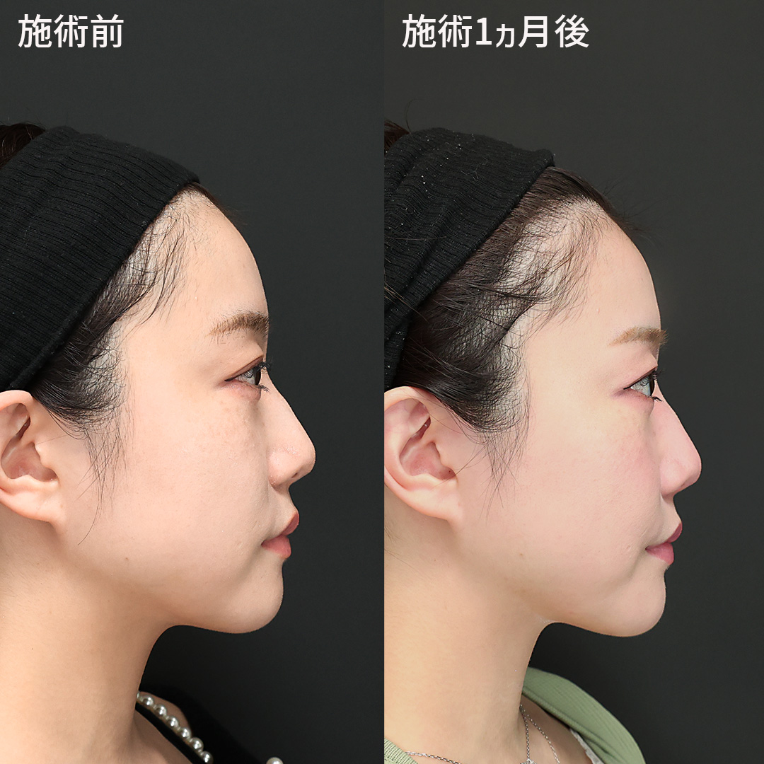 TAC式 ツヤ肌コラーゲンリフト®/エラボトックス注射/顎のヒアルロン酸注射の症例写真 施術前後