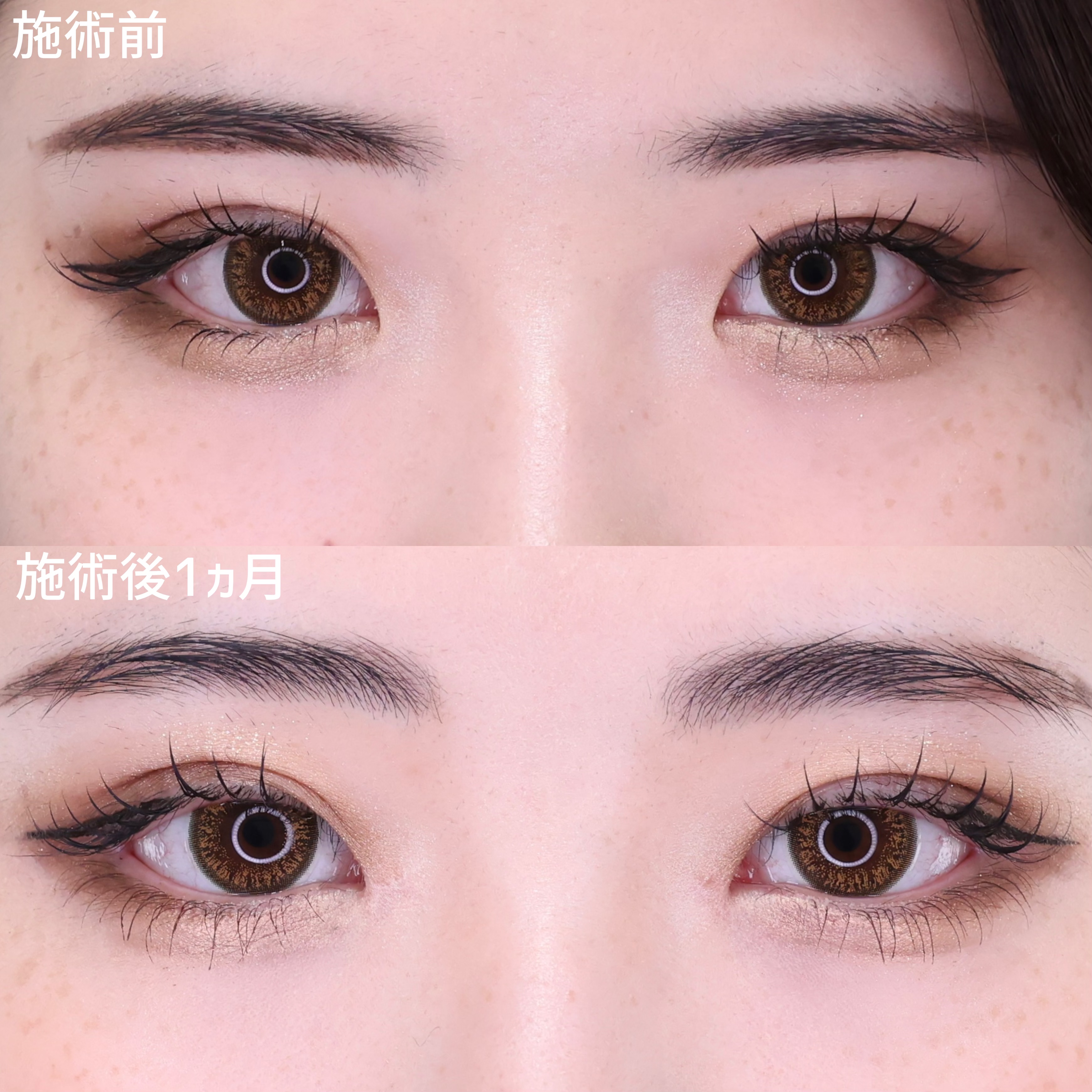 【目頭切開】少しの変化でガラッと変わる印象