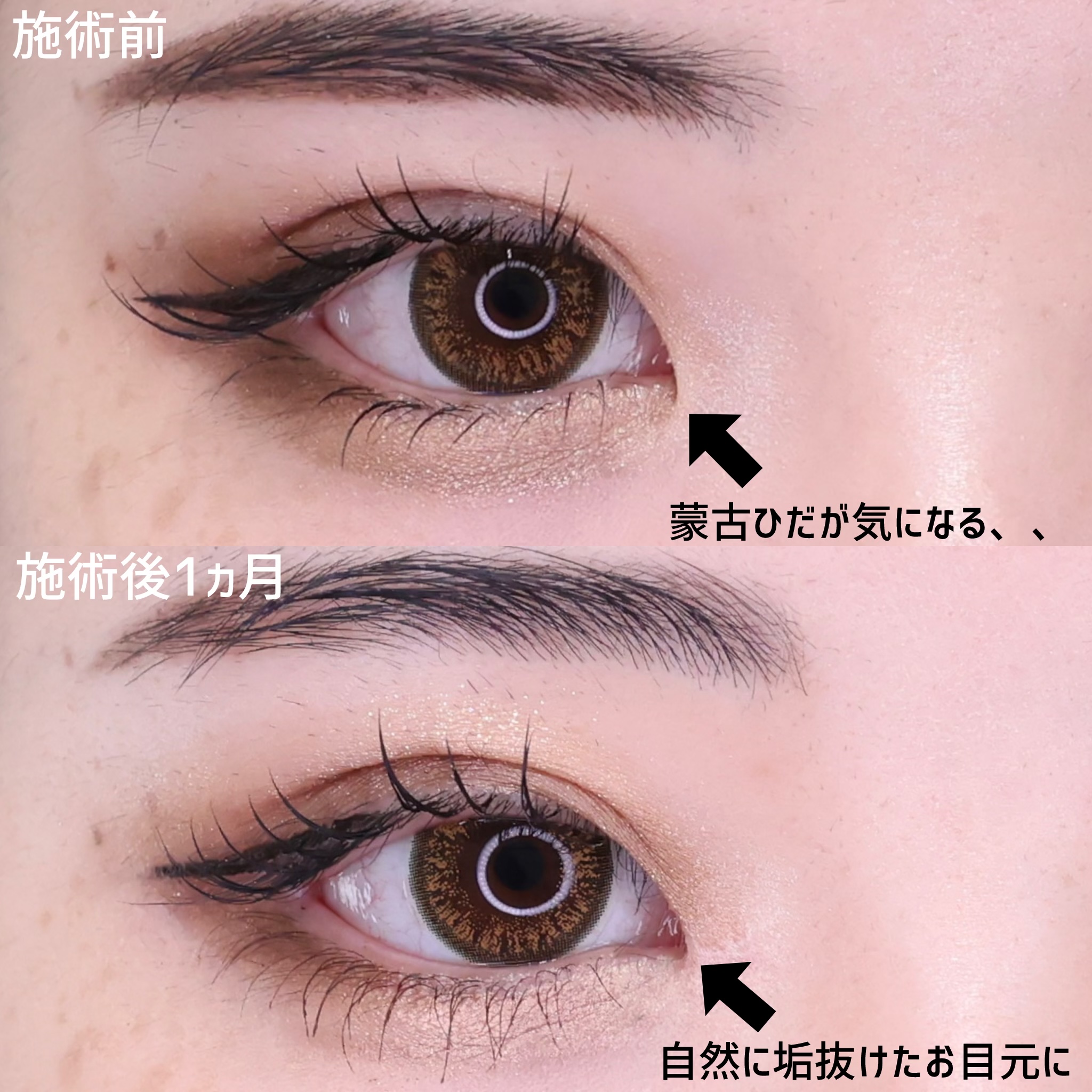 目尻切開術の症例写真 施術前後