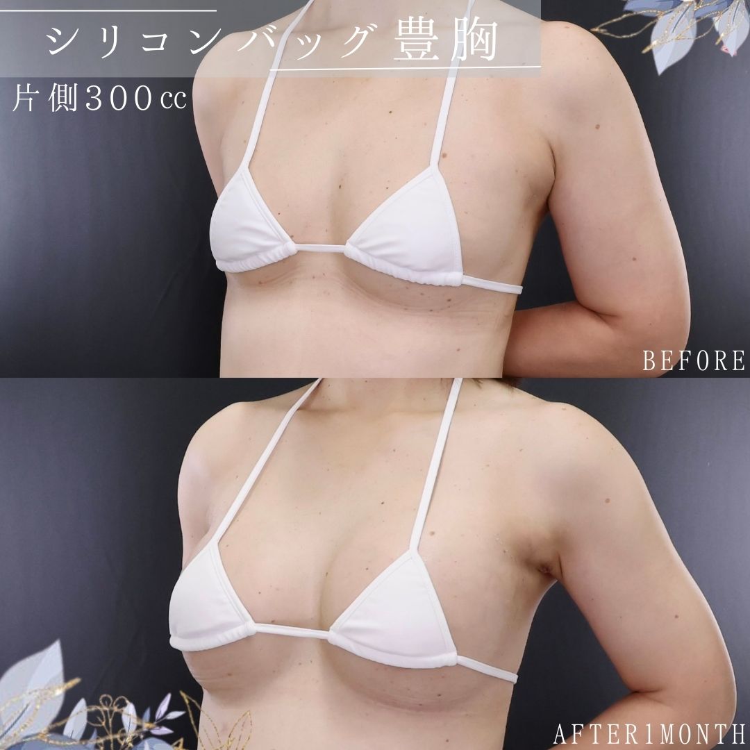 シリコンバッグ豊胸（人工乳腺バッグ）の症例写真 施術前後 
