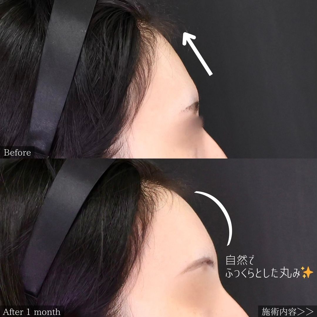 TAC式 ツヤ肌コラーゲンリフト®/顔の脂肪注入(コンデンスリッチフェイス)/エラボトックス注射の症例写真 施術前後