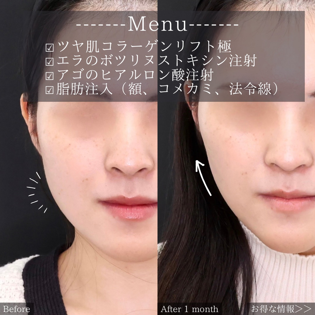TAC式 ツヤ肌コラーゲンリフト®/顔の脂肪注入(コンデンスリッチフェイス)/エラボトックス注射の症例写真 施術前後