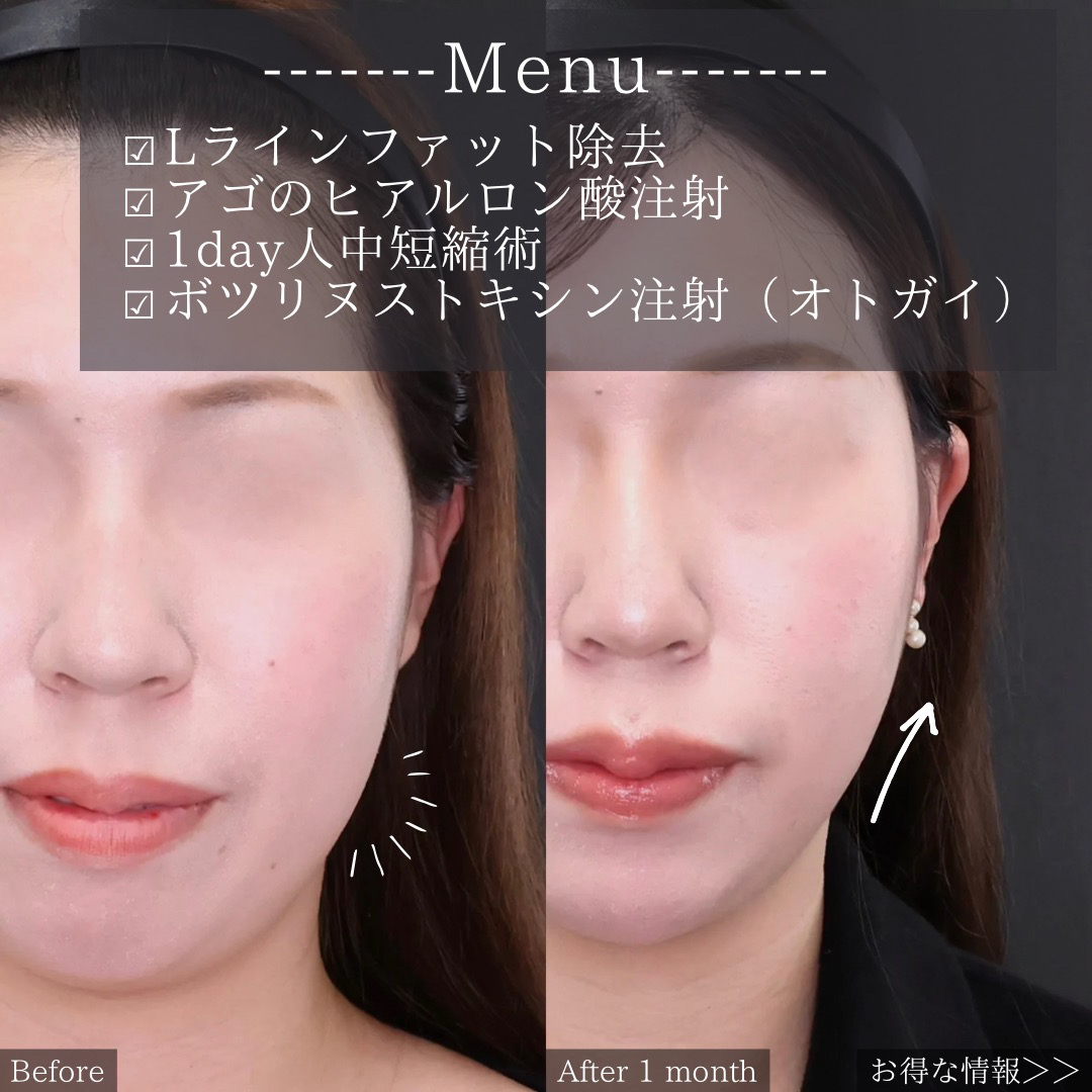 Lラインファット除去（エラ下脂肪除去）/顎のヒアルロン酸注射/ボトックス注射：その他の症例写真 施術前後 