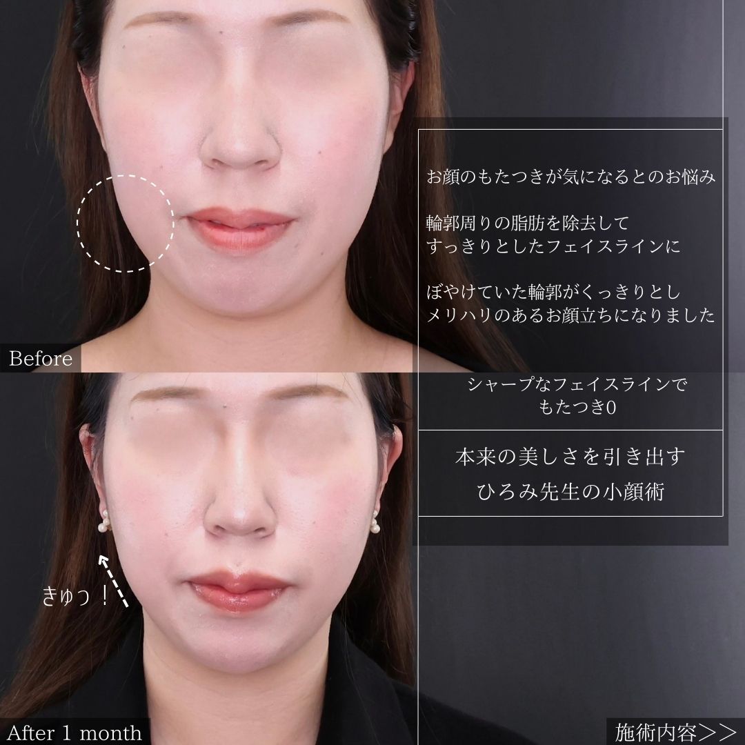 Lラインファット除去（エラ下脂肪除去）/顎のヒアルロン酸注射/ボトックス注射：その他の症例写真 施術前後 