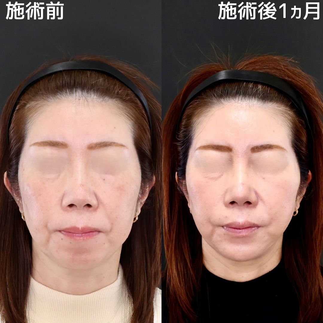 糸リフトで弛みにアプローチ！若々しい印象へ