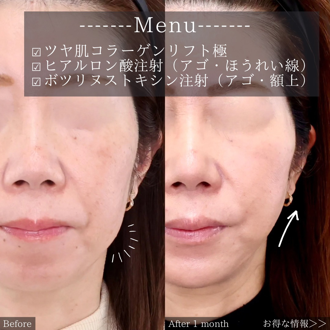 TAC式 ツヤ肌コラーゲンリフト®/顎のヒアルロン酸注射/ボトックス注射：その他の症例写真 施術前後 