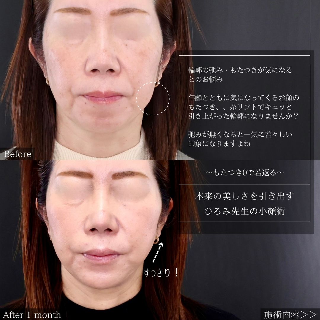 TAC式 ツヤ肌コラーゲンリフト®/顎のヒアルロン酸注射/ボトックス注射：その他の症例写真 施術前後 