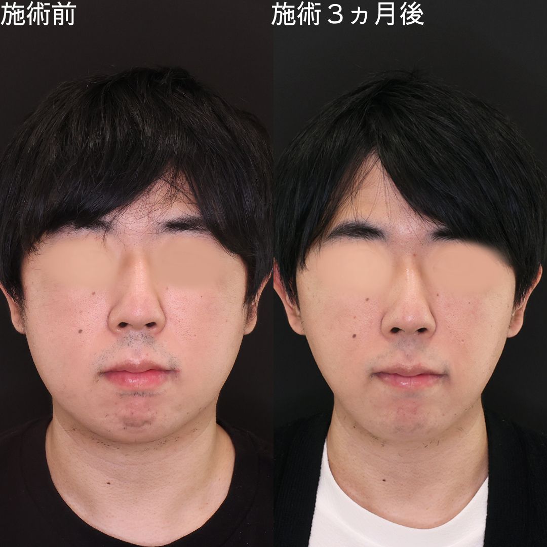 無駄肉解消で垢抜けるDr.石橋のメンズ小顔術【小顔複合術】