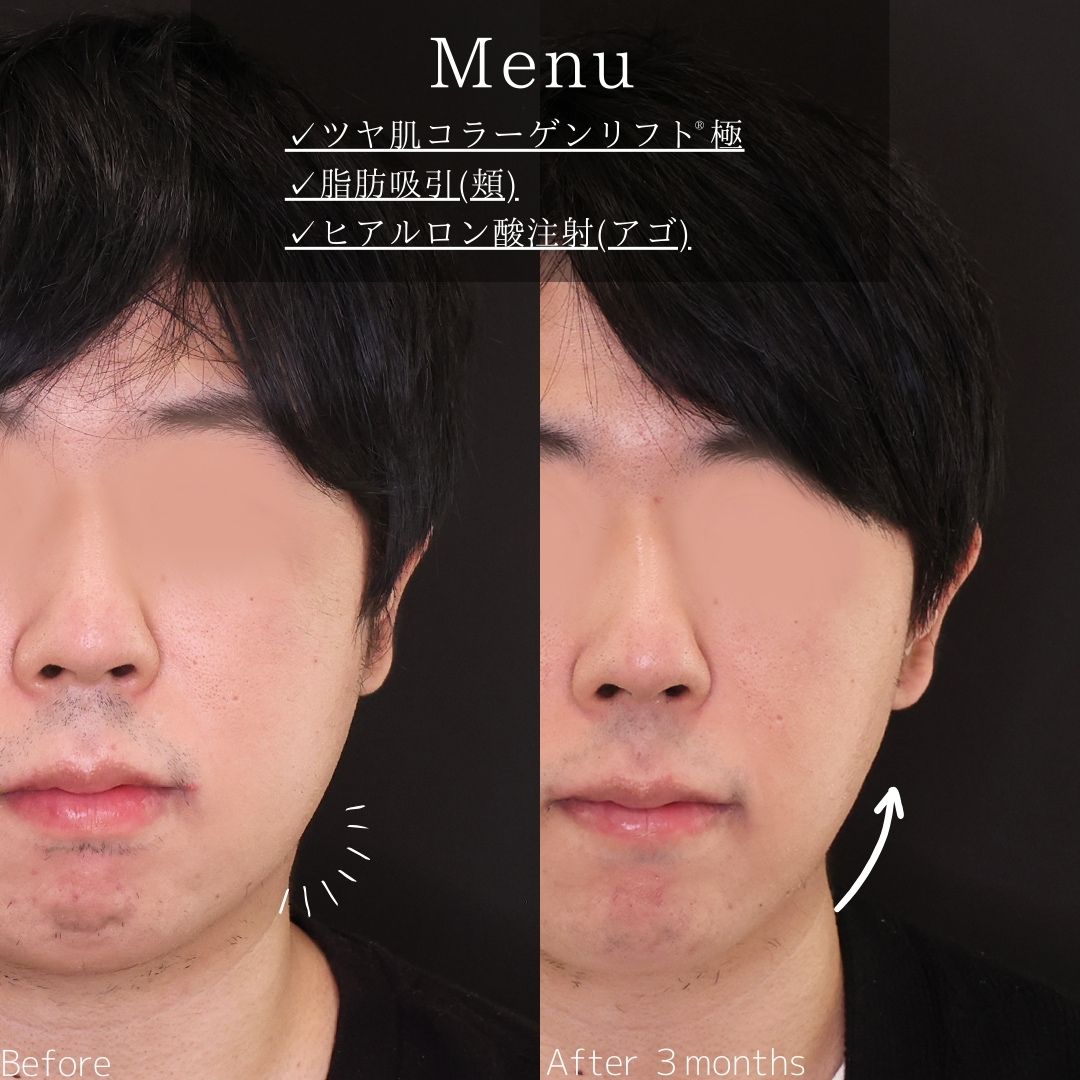 TAC式 ツヤ肌コラーゲンリフト®/顎下の脂肪吸引/顎のヒアルロン酸注射の症例写真 施術前後 
