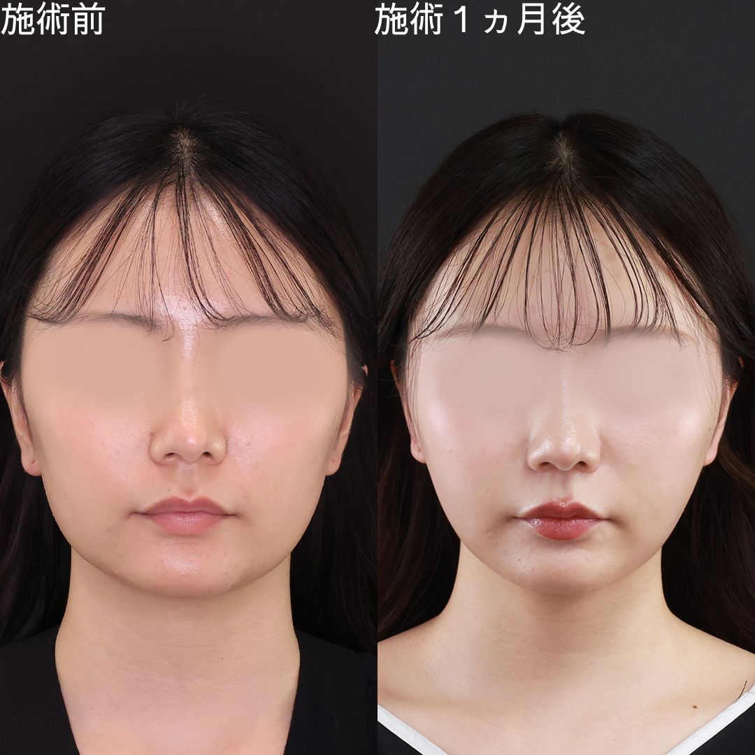 角ばりを改善してアプリ級小顔術【糸リフト×脂肪吸引】