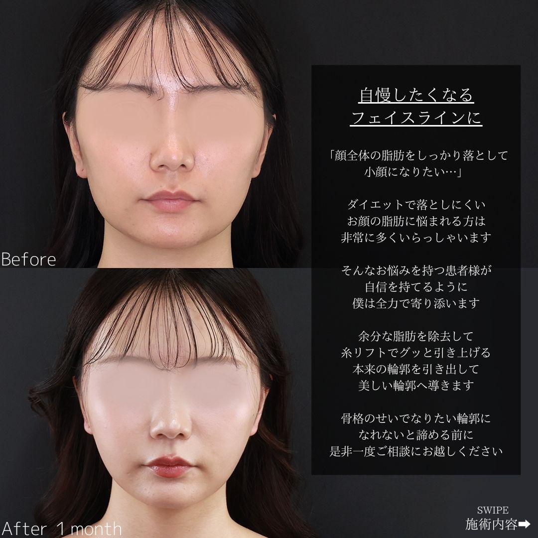 TAC式 ツヤ肌コラーゲンリフト®/顔の脂肪吸引の症例写真 施術前後 