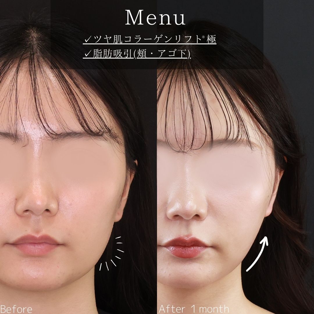 TAC式 ツヤ肌コラーゲンリフト®/顔の脂肪吸引の症例写真 施術前後 