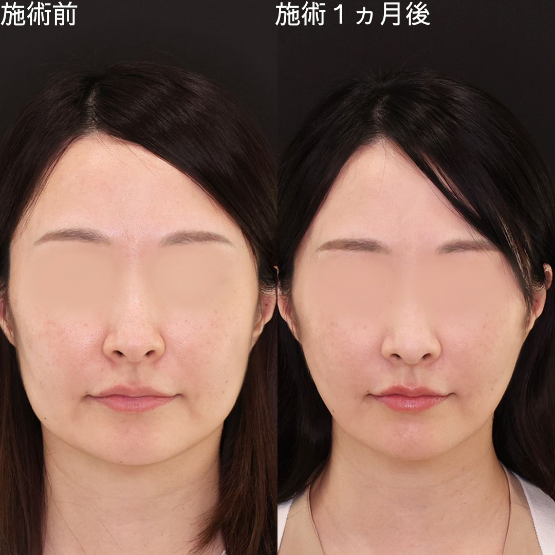 自然な変化で輪郭改善！40代垢抜け小顔術【糸リフト】