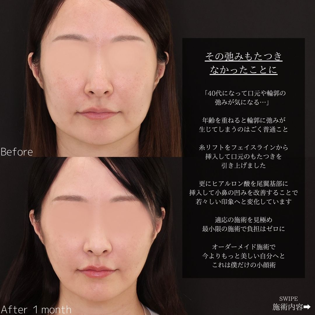 TAC式 ツヤ肌コラーゲンリフト®/ヒアルロン酸注射：その他の症例写真 施術前後 