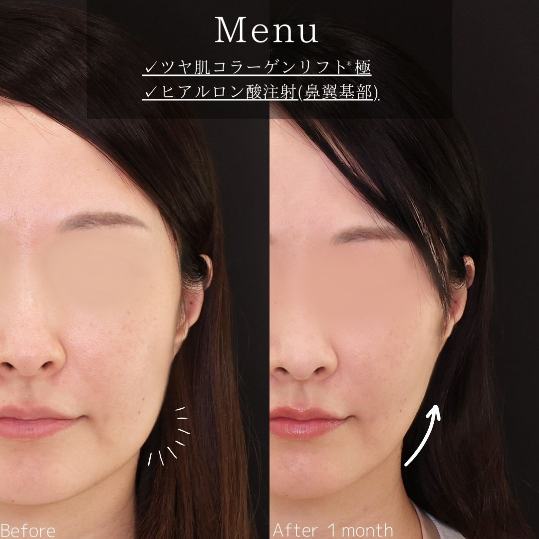TAC式 ツヤ肌コラーゲンリフト®/ヒアルロン酸注射：その他の症例写真 施術前後 