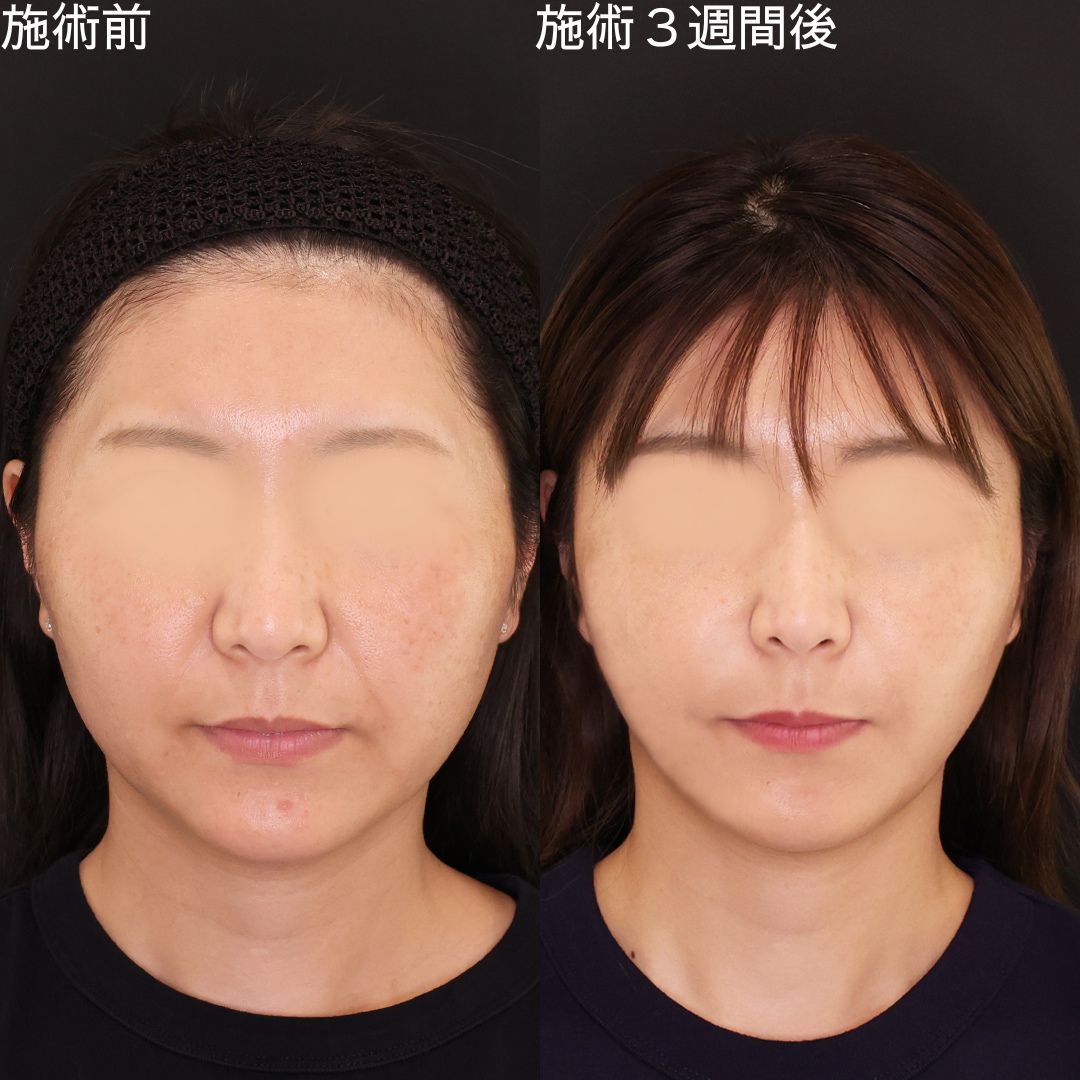 TAC式 ツヤ肌コラーゲンリフト®/ほうれい線のヒアルロン酸注射/エラボトックス注射の症例写真 施術前後