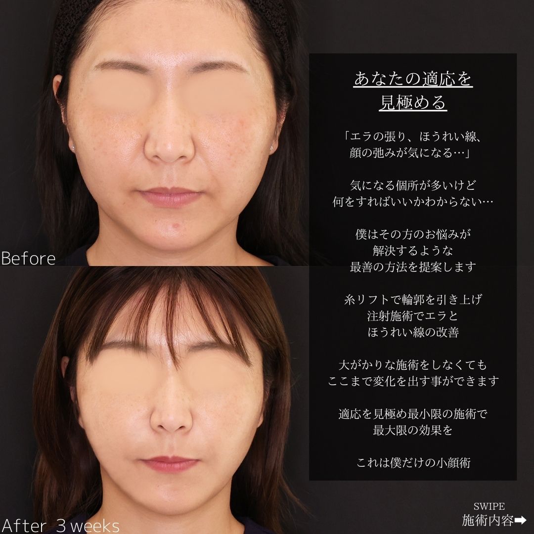 TAC式 ツヤ肌コラーゲンリフト®/ほうれい線のヒアルロン酸注射/エラボトックス注射の症例写真 施術前後