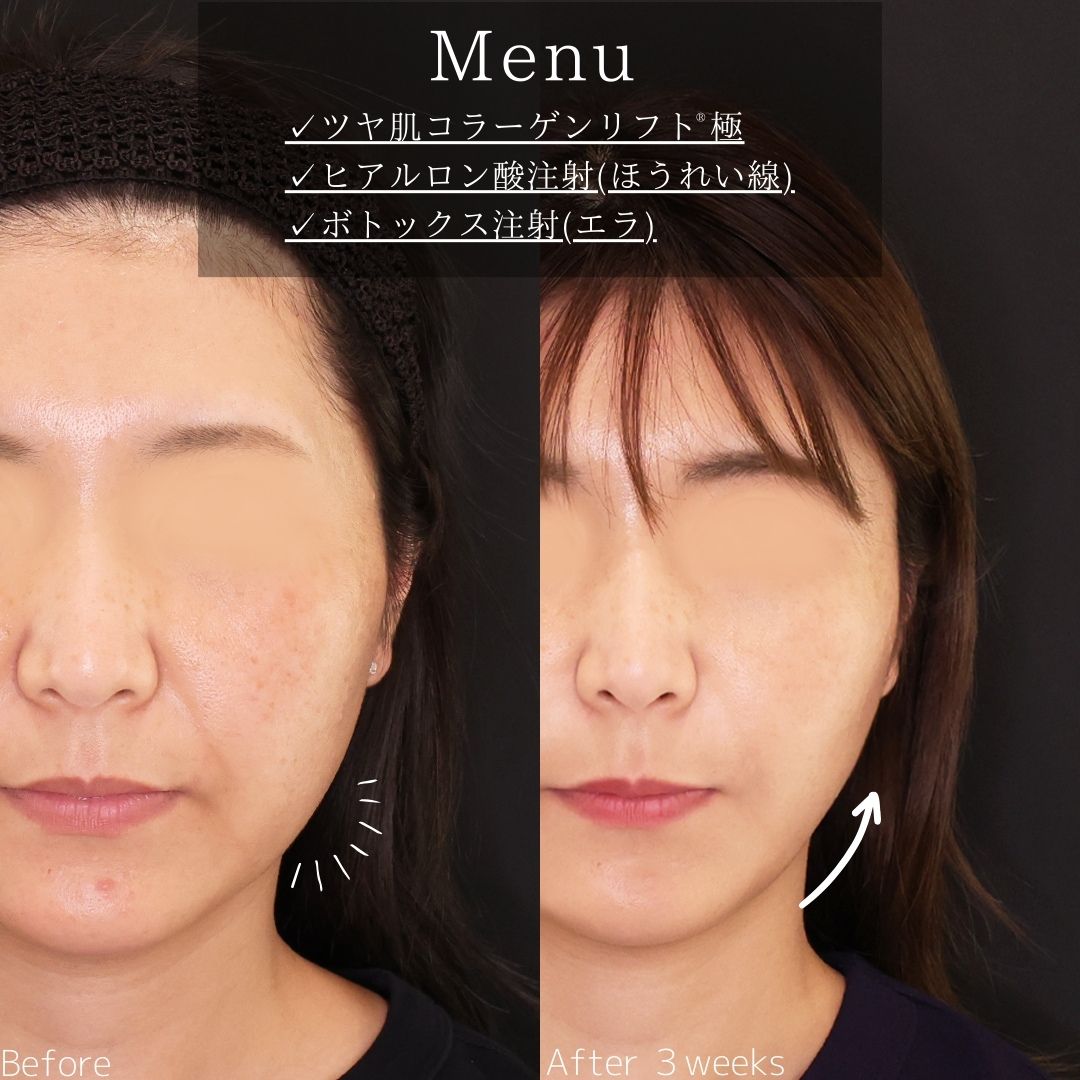 TAC式 ツヤ肌コラーゲンリフト®/ほうれい線のヒアルロン酸注射/エラボトックス注射の症例写真 施術前後