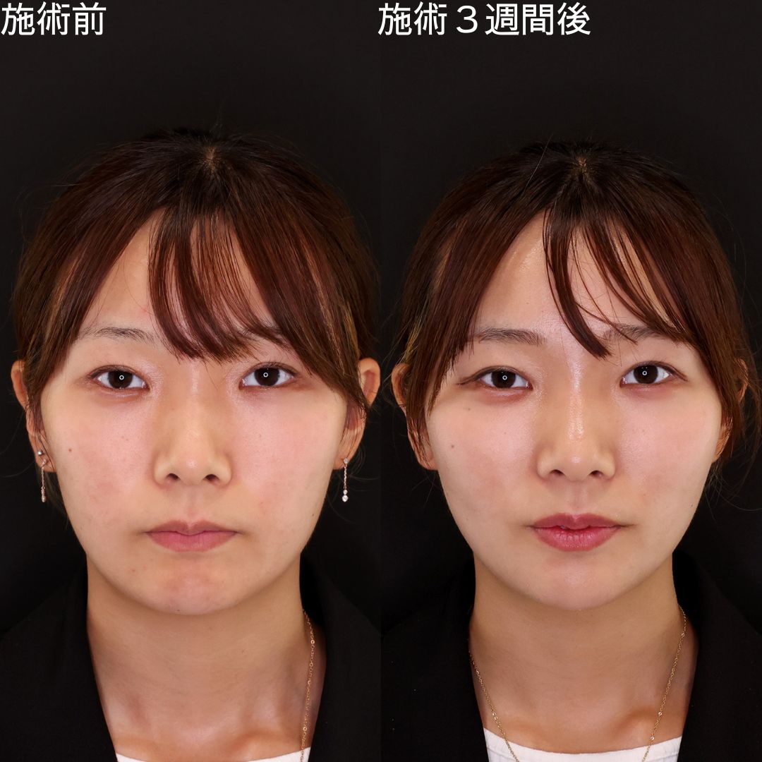 マイルドな変化で理想の輪郭を手に入れる！即日小顔術【糸リフト】