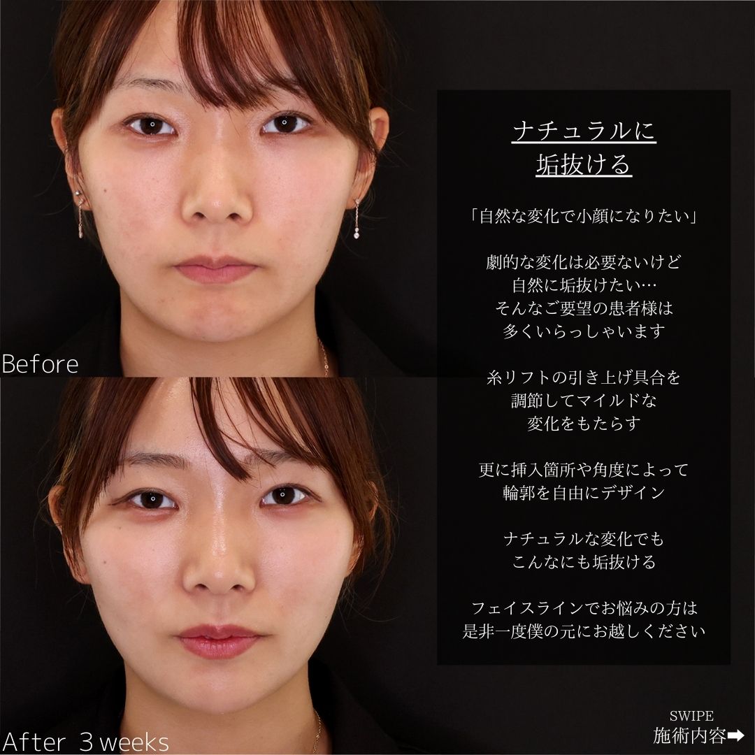 TAC式 ツヤ肌コラーゲンリフト®の症例写真 施術前後 