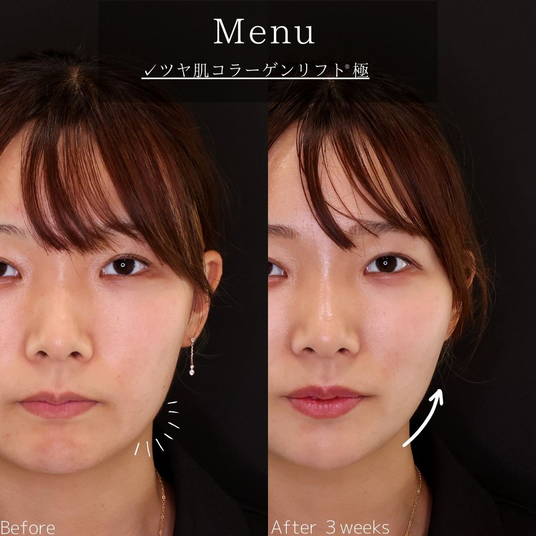 TAC式 ツヤ肌コラーゲンリフト®の症例写真 施術前後 