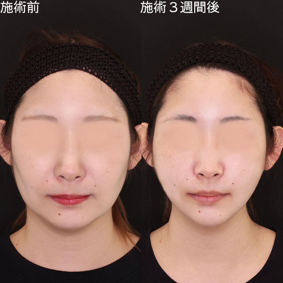 TAC式 ツヤ肌コラーゲンリフト®/エラボトックス注射の症例写真 施術前後