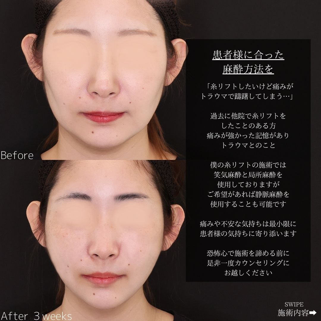 TAC式 ツヤ肌コラーゲンリフト®/エラボトックス注射の症例写真 施術前後