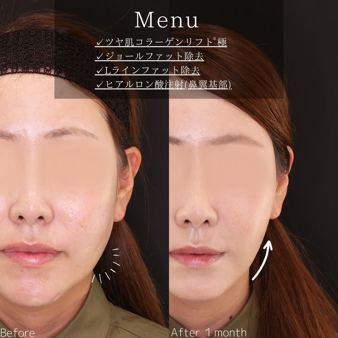 TAC式 ツヤ肌コラーゲンリフト®/ジョールファット除去/Lラインファット除去（エラ下脂肪除去）の症例写真 施術前後 