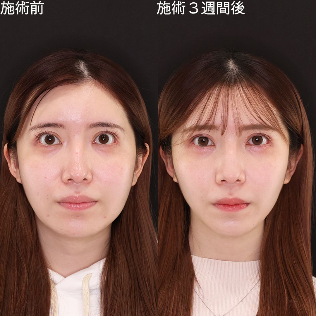 たった15分で弛み0に！女優級小顔術【糸リフト】