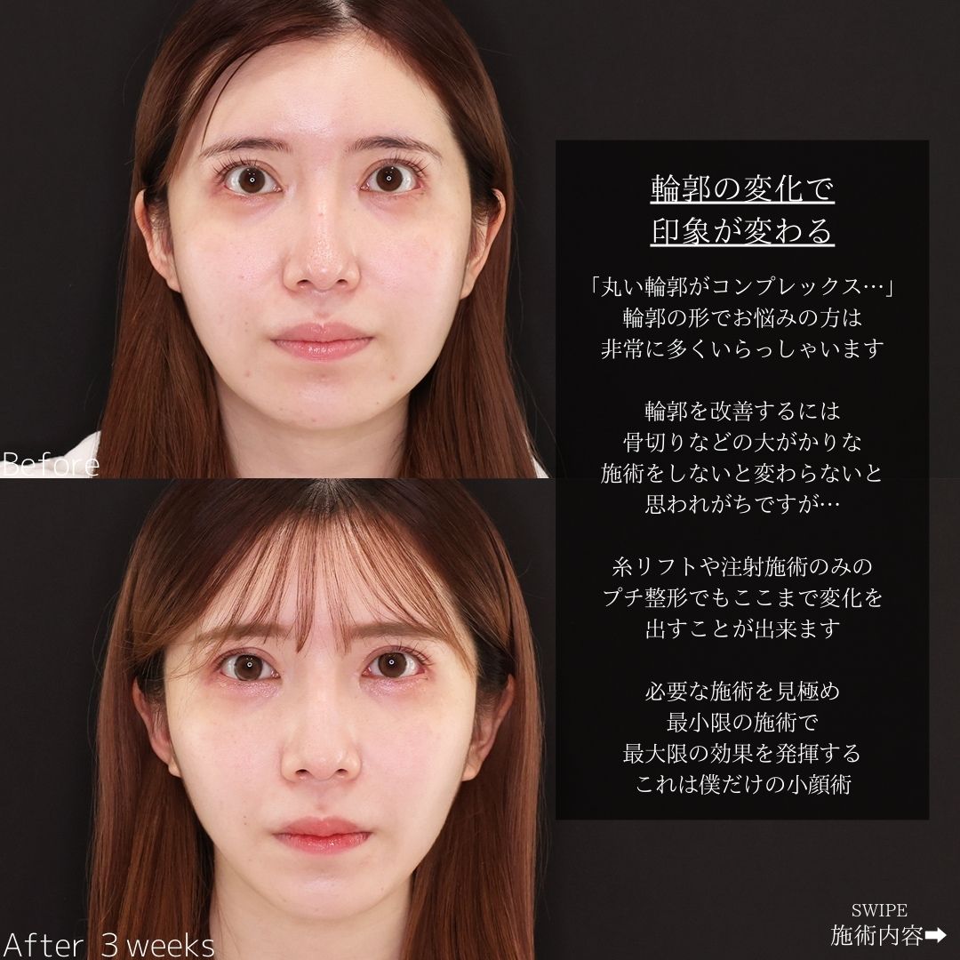 TAC式 ツヤ肌コラーゲンリフト®/ほうれい線のヒアルロン酸注射の症例写真 施術前後 